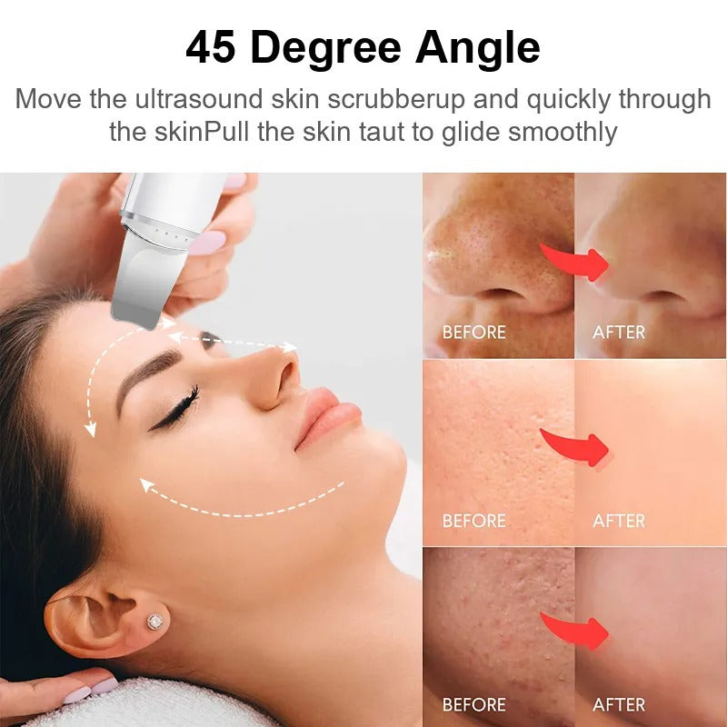 Ultrasonic Skin Exfoliator